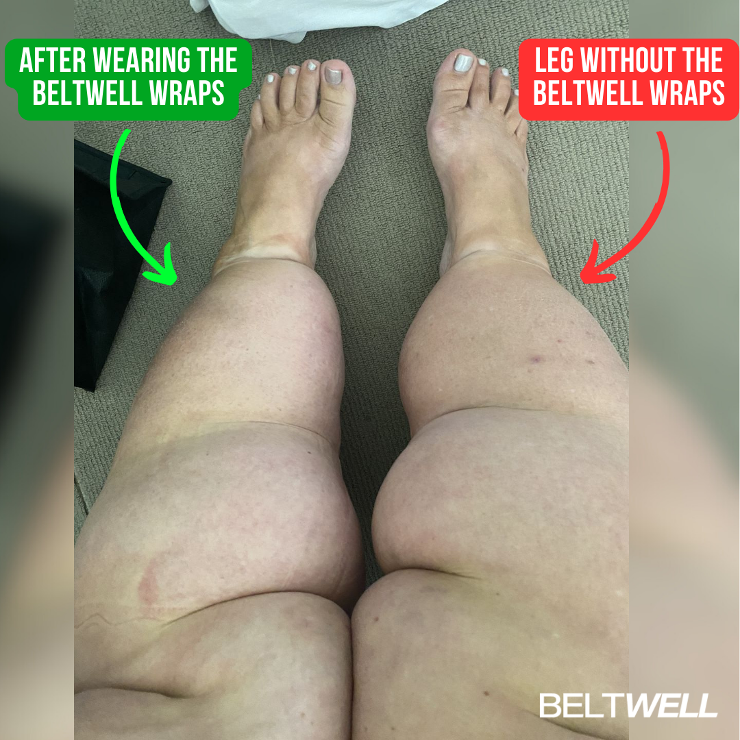 Édition Limitée Beltwell® Genouillère Réglable pour Jambes Très Gonflées (1 genouillère)
