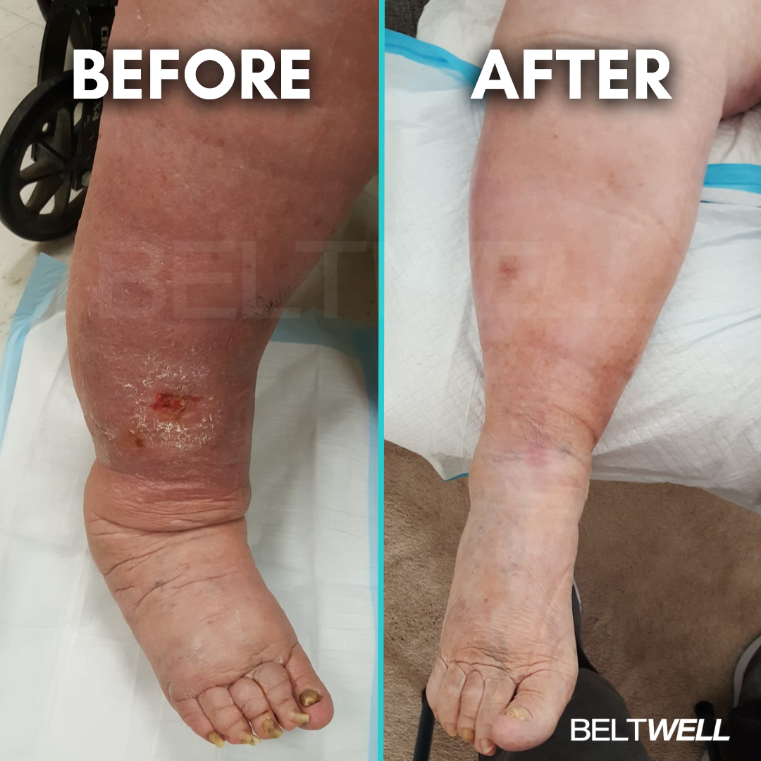 Édition Limitée Beltwell® Genouillère Réglable pour Jambes Très Gonflées (1 genouillère)