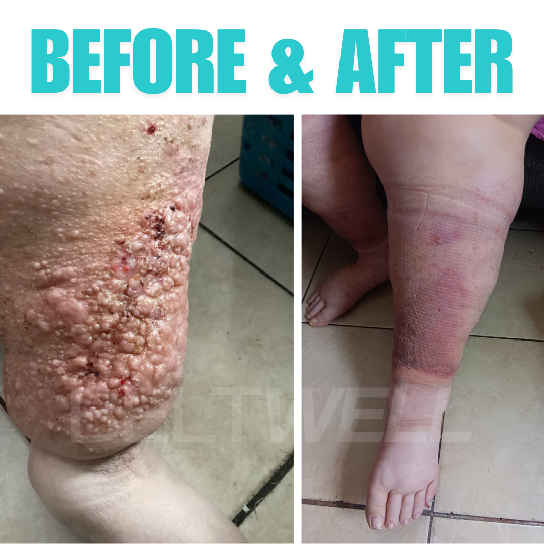 Édition Limitée Beltwell® Genouillère Réglable pour Jambes Très Gonflées (1 genouillère)
