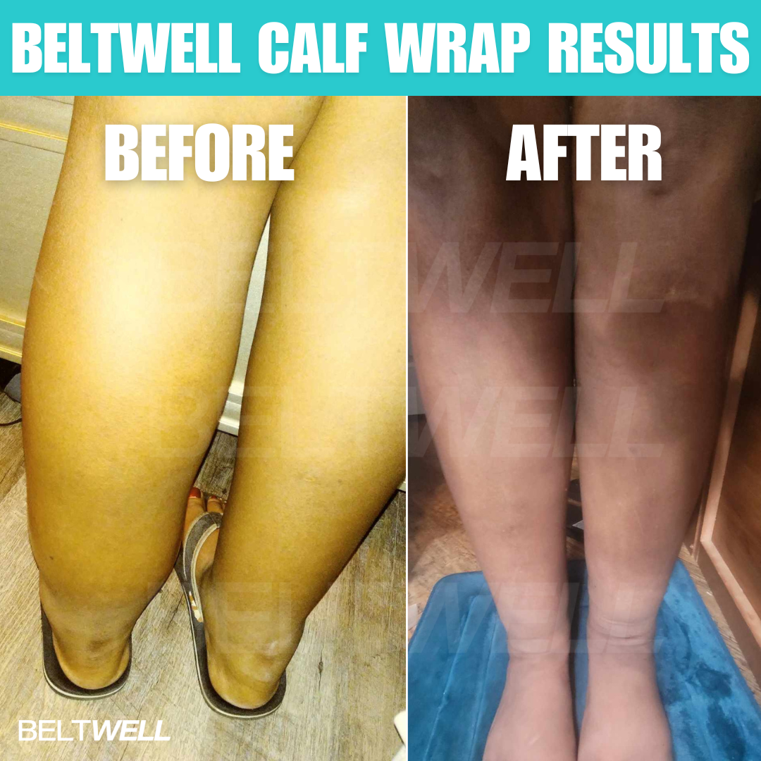 Édition Limitée Beltwell® Genouillère Réglable pour Jambes Très Gonflées (1 genouillère)