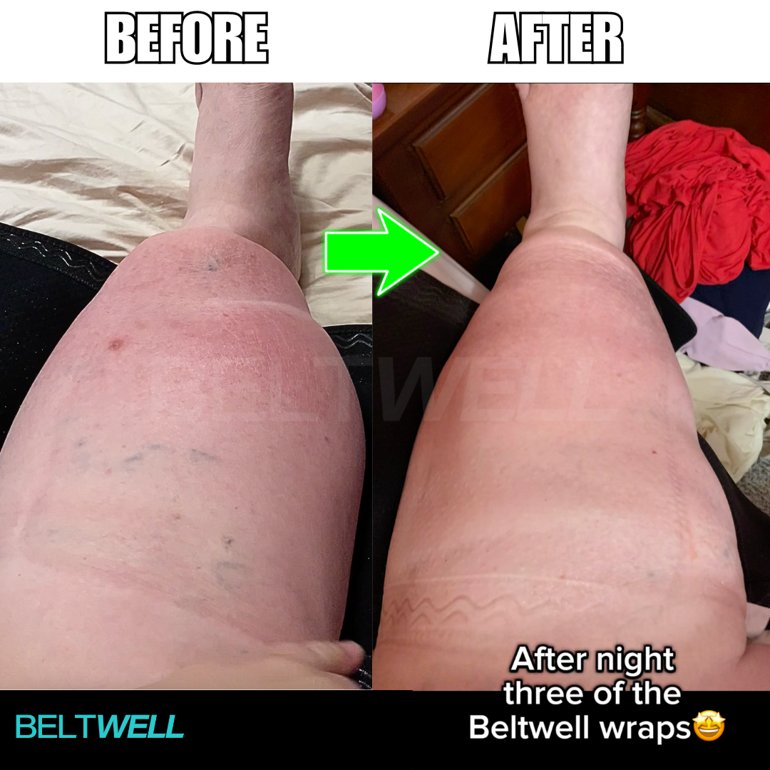 Édition Limitée Beltwell® Genouillère Réglable pour Jambes Très Gonflées (1 genouillère)